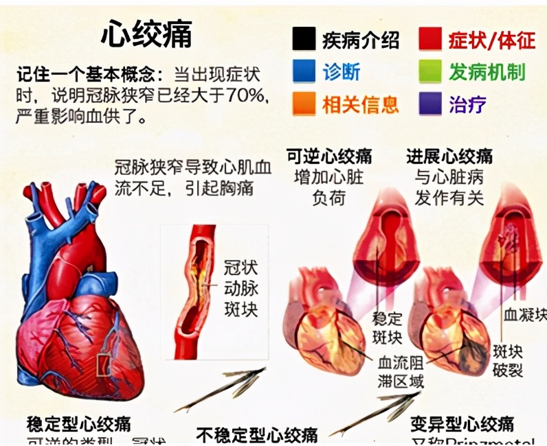 心肌缺血心绞痛用什么药好用,抗心肌缺血的药有哪些