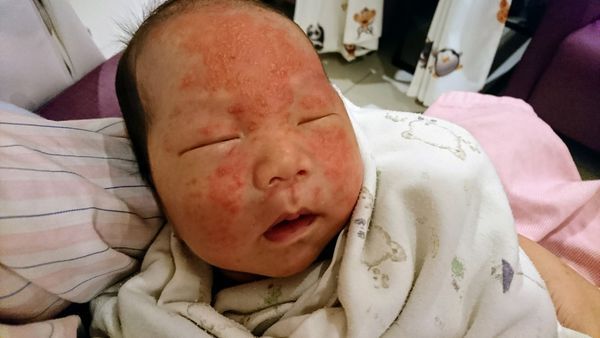 新生儿脂溢性皮炎怎么治疗最彻底,新生儿脂溢性皮炎用什么护理