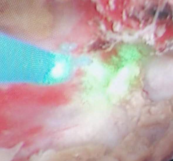 输尿管结石最好的方法是怎么治,输尿管结石怎么办最快最有效