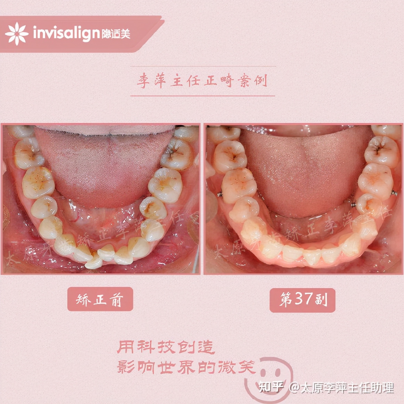 太原牙齿矫正靠谱吗,太原成人隐形牙套牙齿不齐
