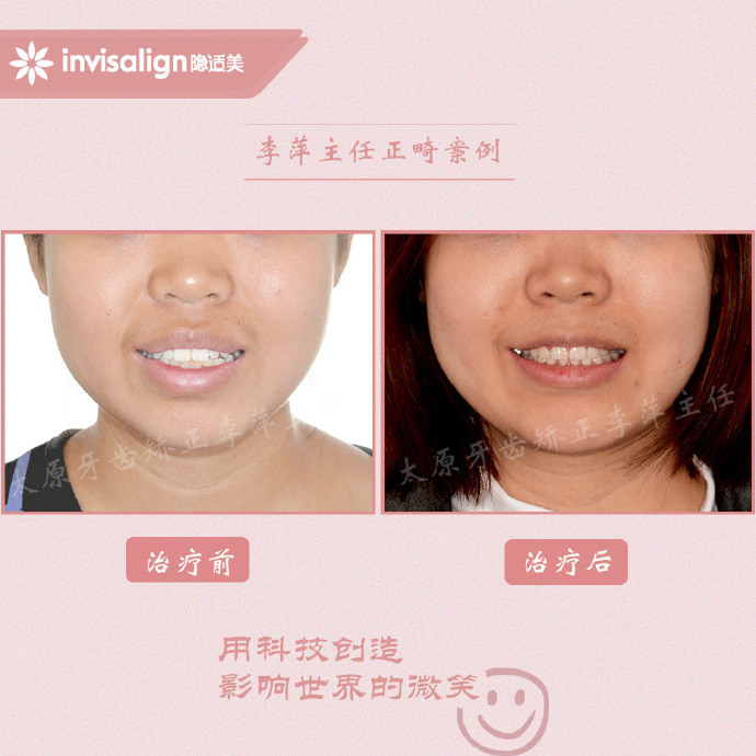 龅牙矫正牙齿能解决下颌后缩么,儿童正畸能解决鼻基底凹陷问题吗