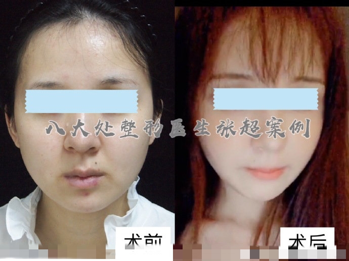 八大处整形张超,八大处张超最新视频