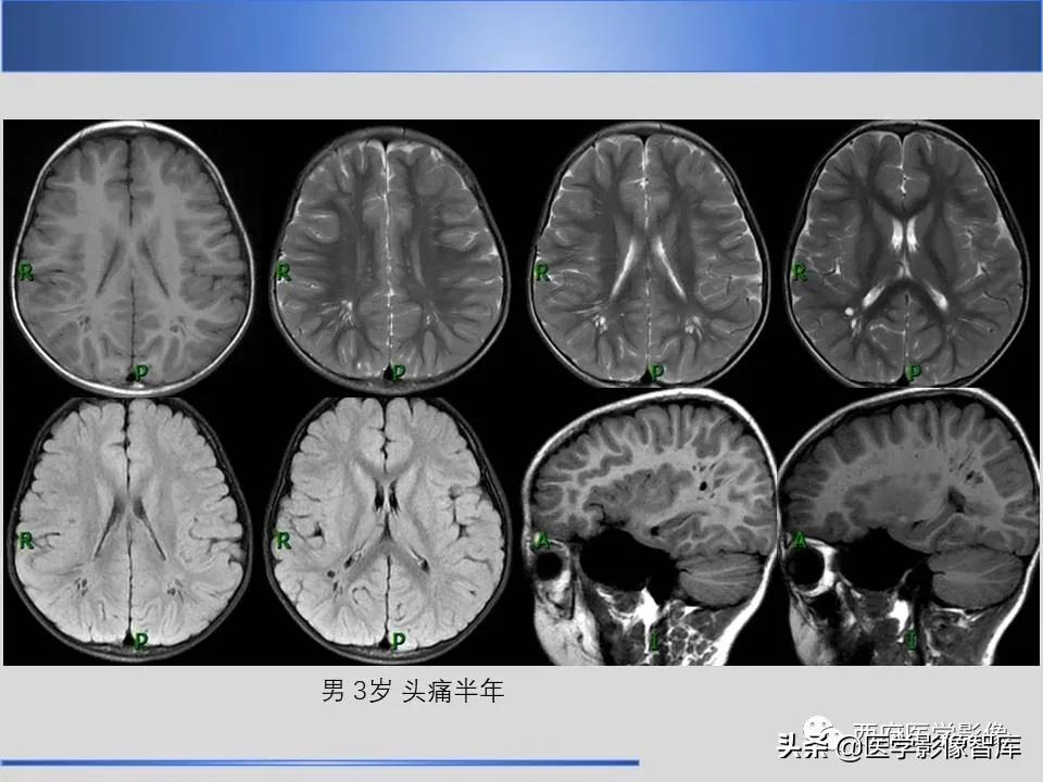vr间隙概念,vr间隙需要做什么检查