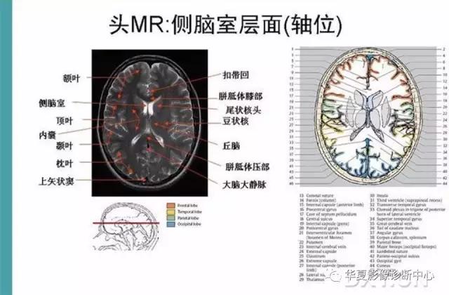 电子版头颅ct与mri断层解剖,头颅mri血管解剖与分段详解