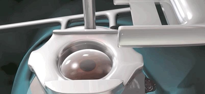 激光治疗近视什么原理,激光矫正是什么原理