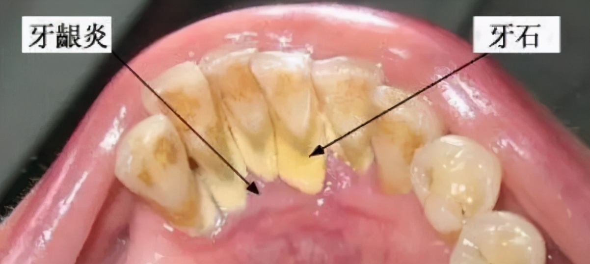 蛀牙与牙周炎哪个更严重,慢性牙周炎口腔健康的头号杀手