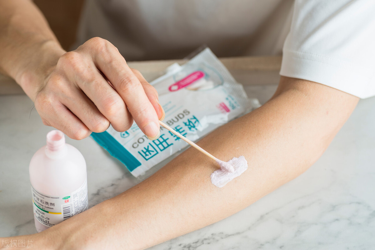 荨麻疹痒吃药不管用怎么办,荨麻疹瘙痒难忍中医一个方子改善