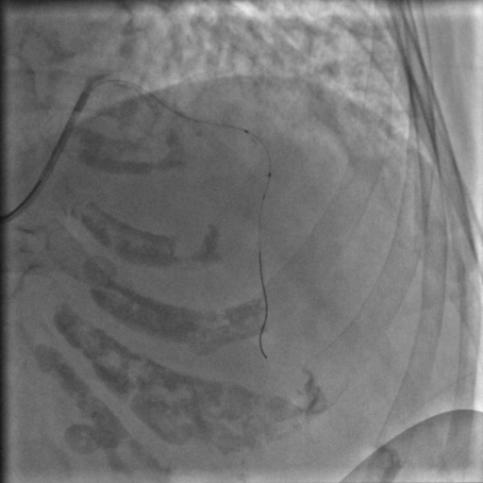 85岁老人心脏堵塞,77岁老人冠脉狭窄放支架还是搭桥