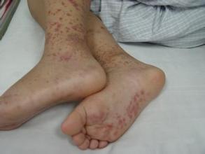 腹部过敏性紫癜腹痛会持续多久,腹型过敏性紫癜会胃疼吗