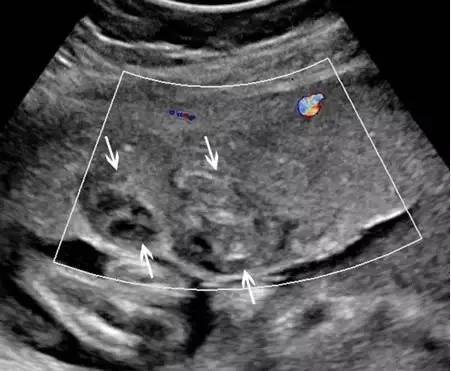 临床上最常见的异常胎盘,前置胎盘和低置胎盘超声