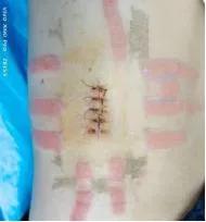 地塞米松新用途：轻松搞定医用胶粘剂相关性皮炎