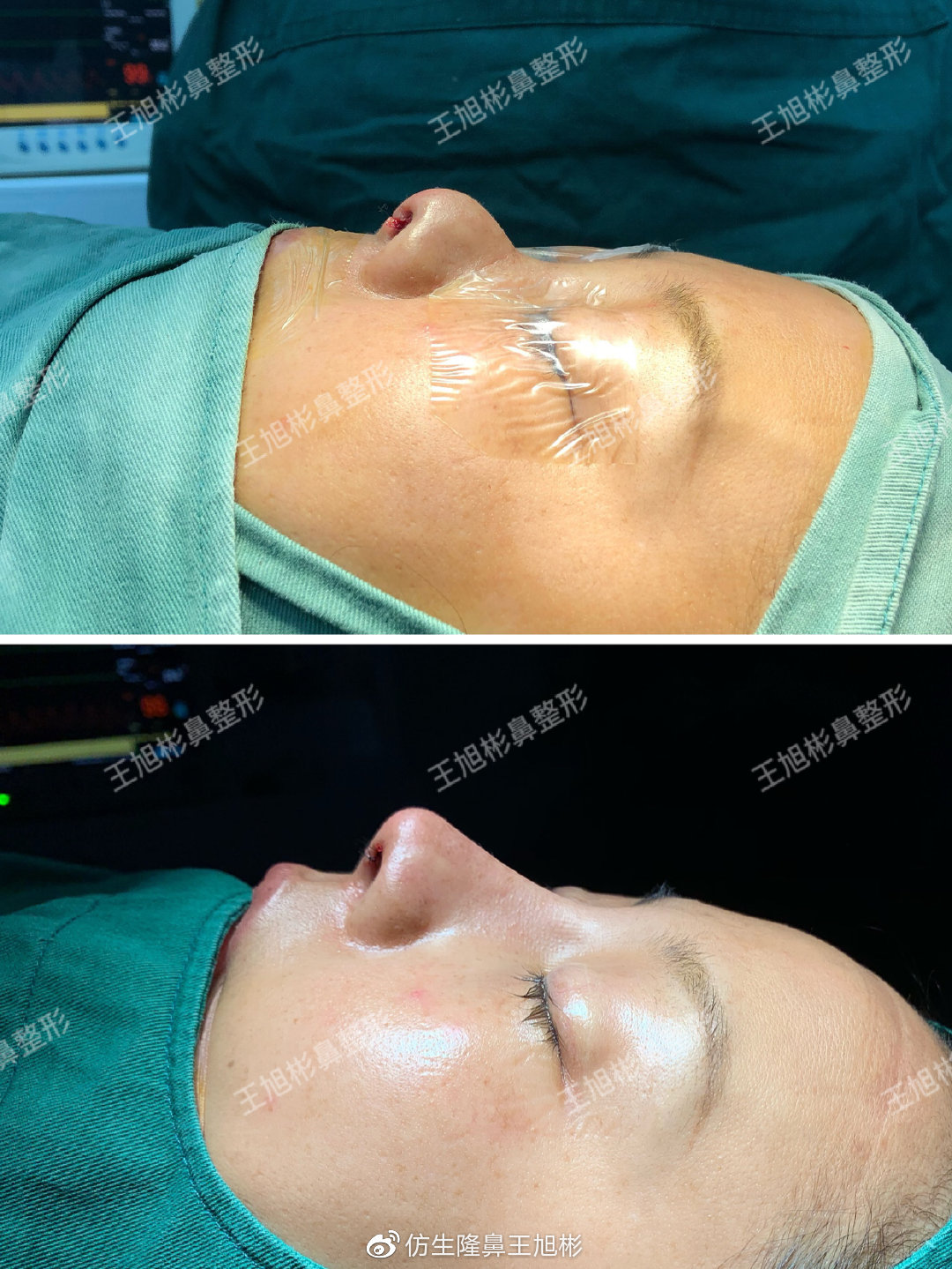 短鼻蒜头鼻整形,短鼻延长术切口