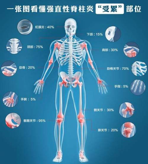 腰背、关节疼痛，先到风湿免疫科就诊，排除强直性脊柱炎
