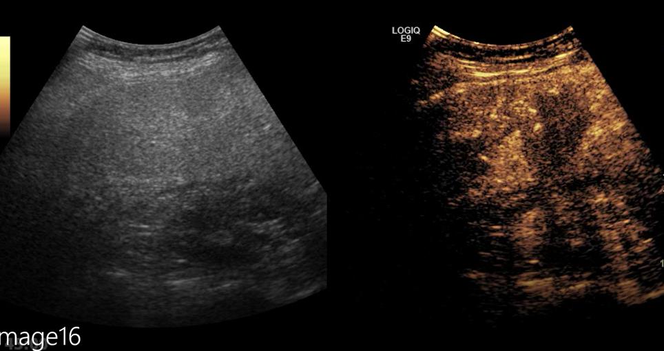 胃癌转移肝介入治疗有疗效吗,胃癌转移到肝脏做靶向治疗