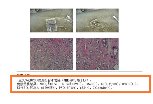 浸润性乳腺癌病理分型及预后,乳腺癌的病理分型和预后