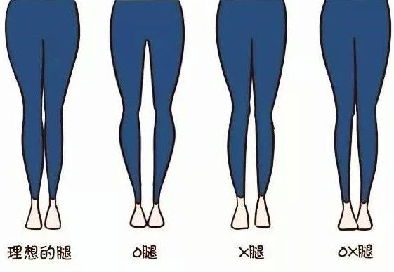 两腿并拢大腿有缝隙怎么练改善,双腿并拢时大腿处有缝隙怎么办