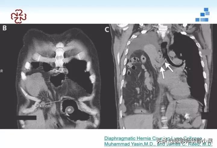 「精品课件」胸部膈肌的解剖及常见病变影像的表现