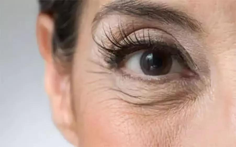 脂肪粒怎么用针挑出的,脂肪粒多久可以用针挑出来