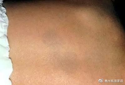 婴儿尿布湿疹的最快自愈方法,婴儿湿疹痤疮尿布疹