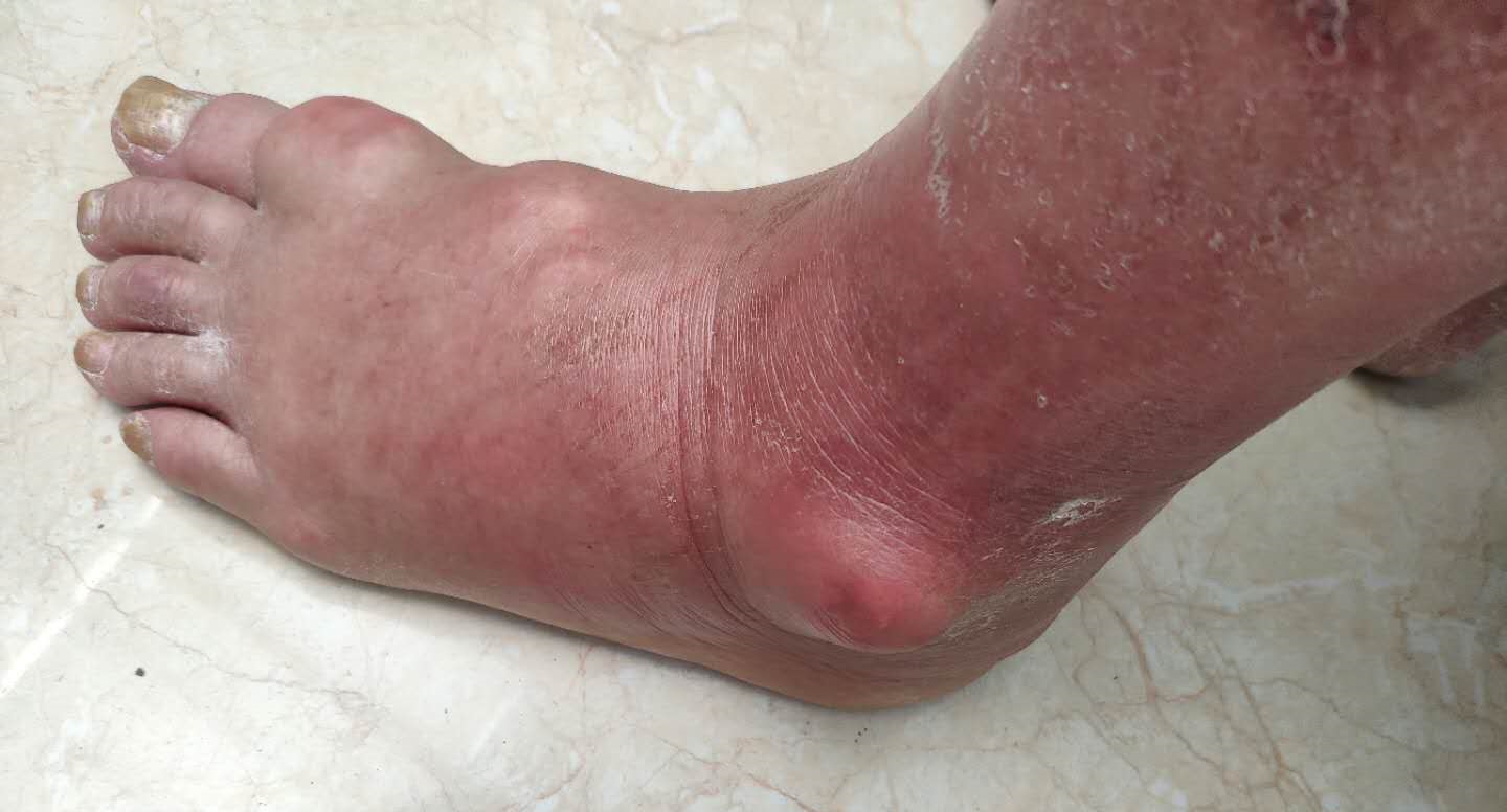 头疼全身酸痛发热是不是新冠肺炎,新冠肺炎发热是持续的还是反复的