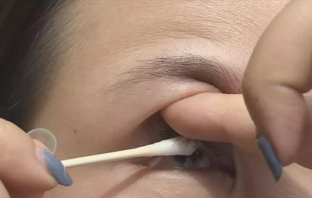 婴儿眼睛上有异物怎么处理,眼睛里感觉有异物磨眼睛怎么处理