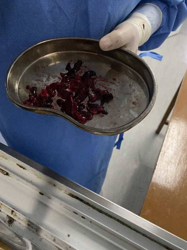 芜湖：网络主播为求美选择隆胸手术后却流血不止…