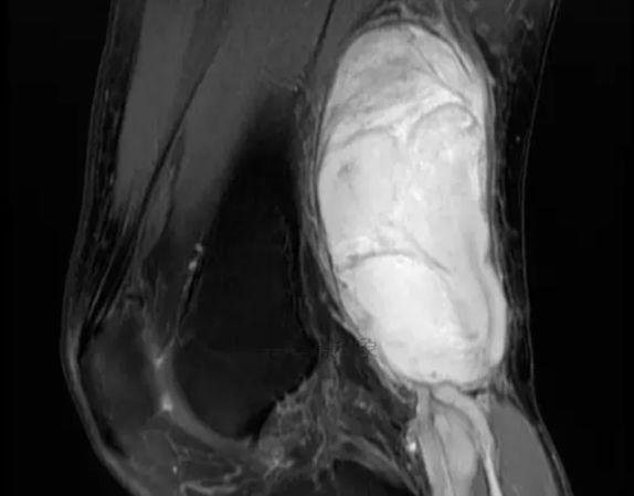 身上长很多包是什么癌,身上长包块去什么医院