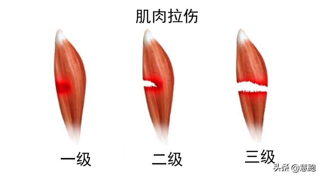 谢震业伤缺，中国接力赛扔跑出世界第六！肌肉拉伤如何康复？