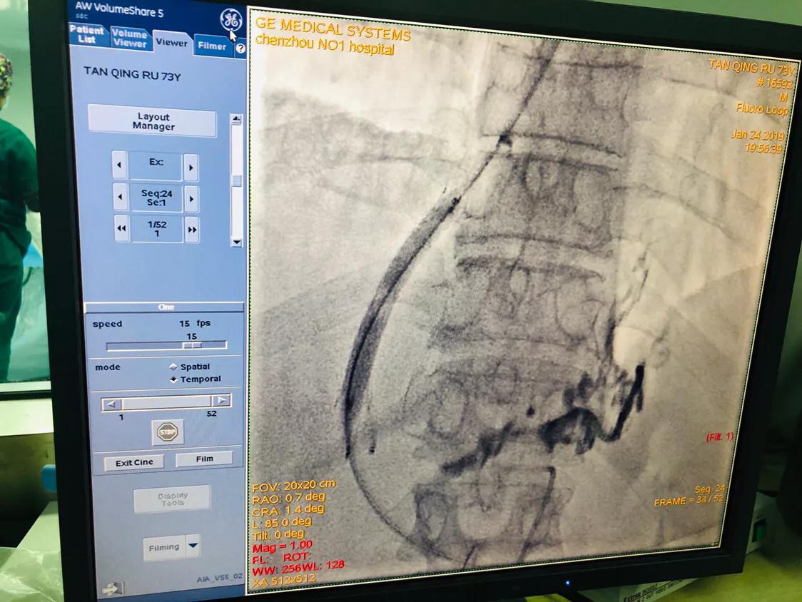 中医治疗肝硬化消化道出血,出奇制胜完整版