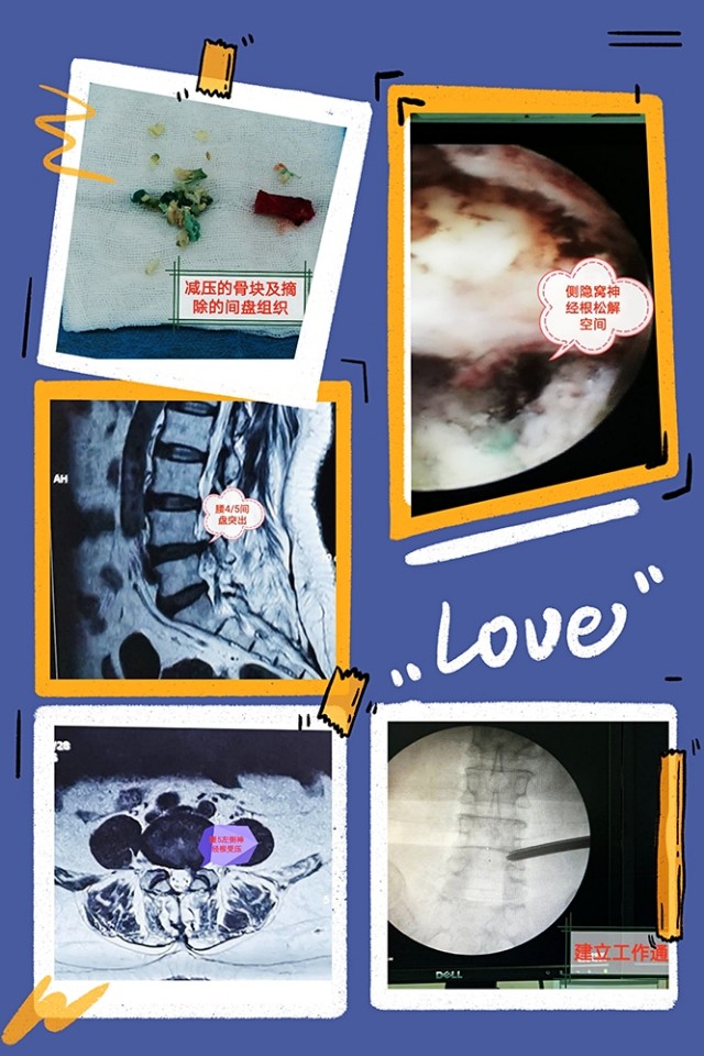 专家治疗腰椎间盘突出症的手法,专家教你快速治疗腰椎间盘突出