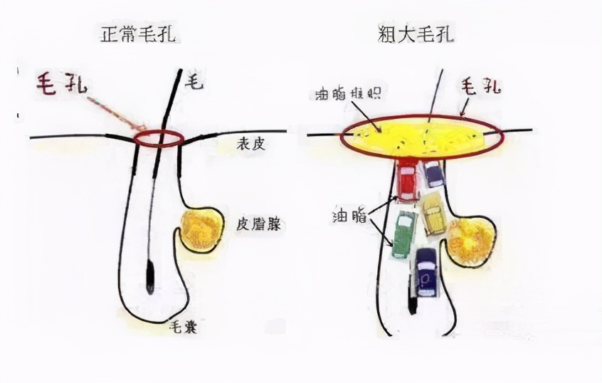 混干皮瑕疵皮毛孔粗大博主推荐,油皮瑕疵皮毛孔粗大