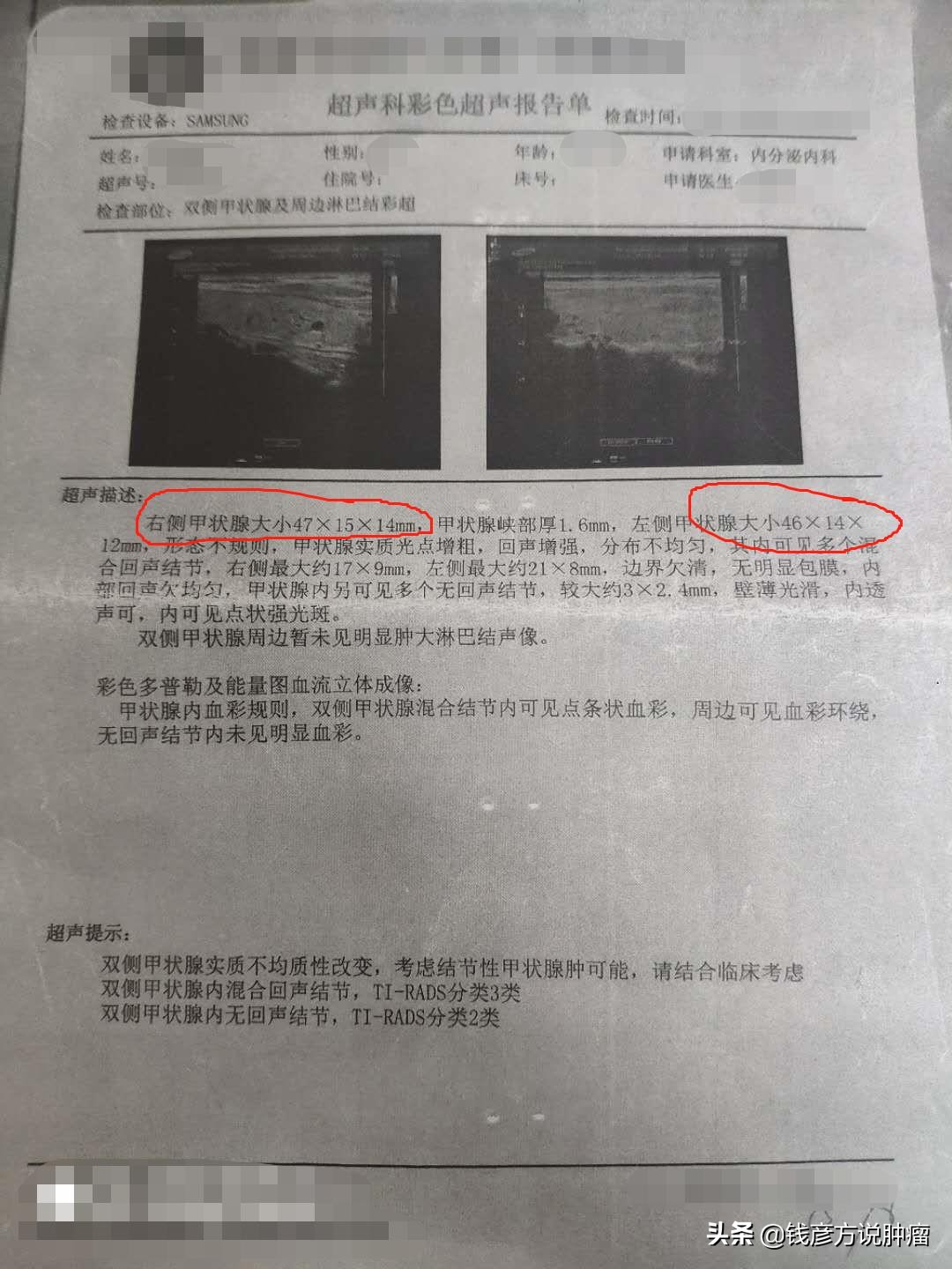 甲状腺结节3类有药吃能治好吗,甲状腺结节3类喝中药能治好么