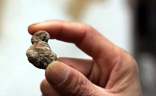 肾结石自我治疗真实经历分享,肾结石痛的时候怎么快速排出结石