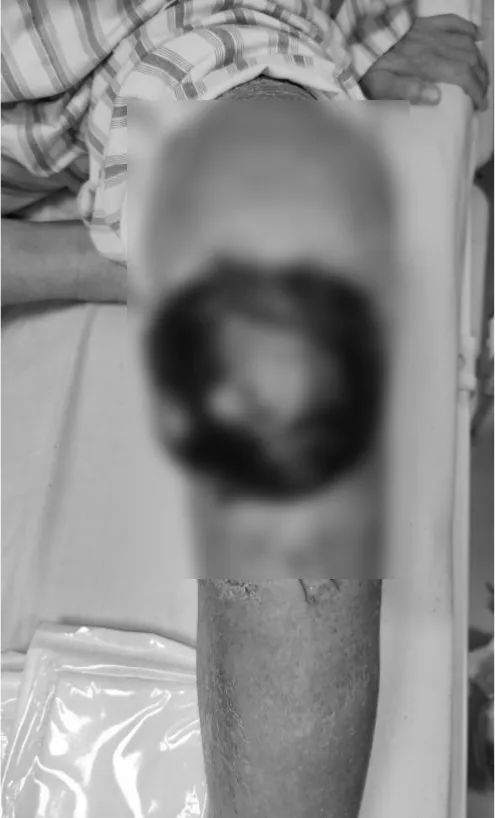 男士膝盖破了怎么办,膝关节破了个洞