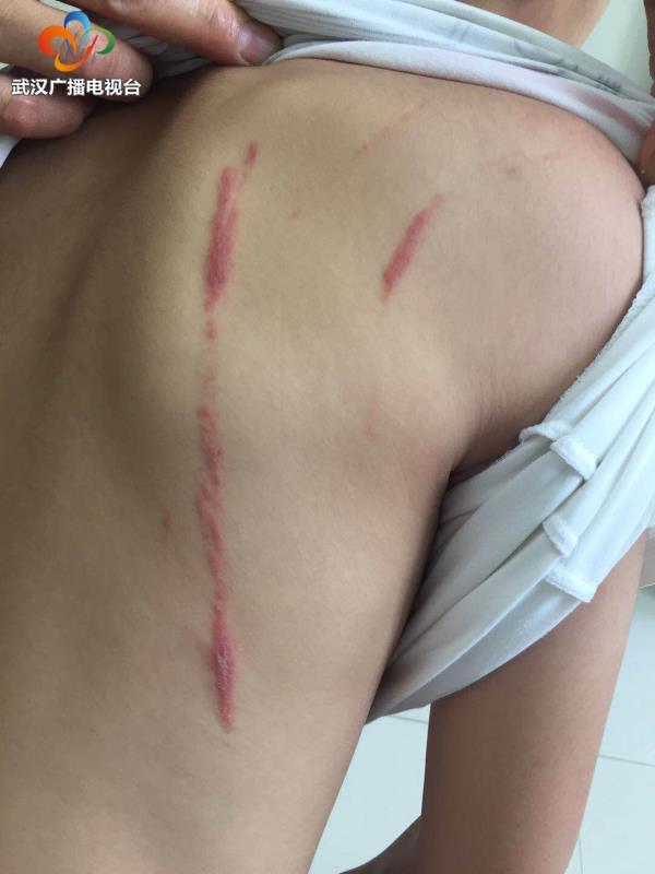 孩子身上有一条一条的痕迹痒,孩子身上感觉有虫子爬痒怎么回事