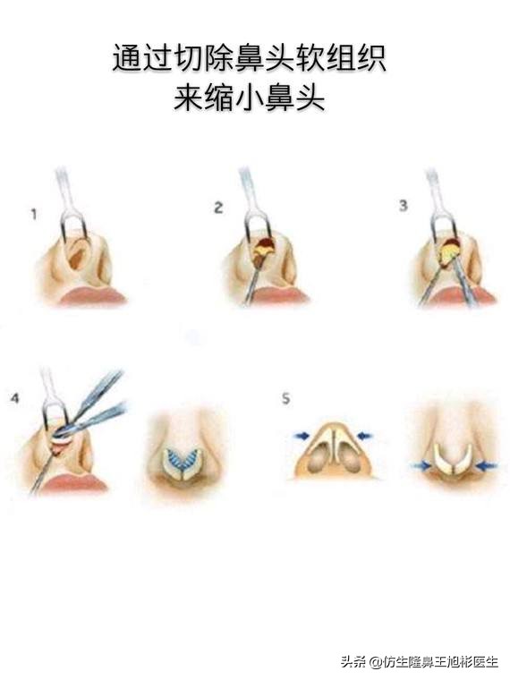 鼻尖高了怎么修复,鼻尖太大怎么矫正