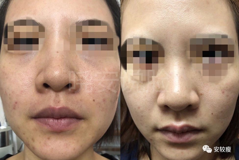 外油内干敏感痘肌怎么护肤,30岁油皮痘痘敏感肌怎么改善