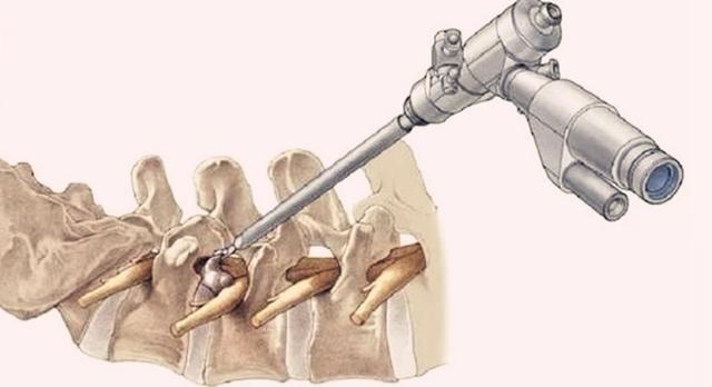 教你一招治腰椎间盘突出,治疗腰椎间盘突出的几个方法