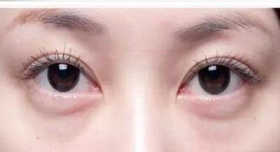 如何去眼袋和皱纹最有效,去眼袋皱纹直播间