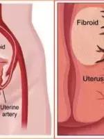 子宫肌瘤腺肌症微创介入科普动画,子宫肌瘤适合微创手术吗