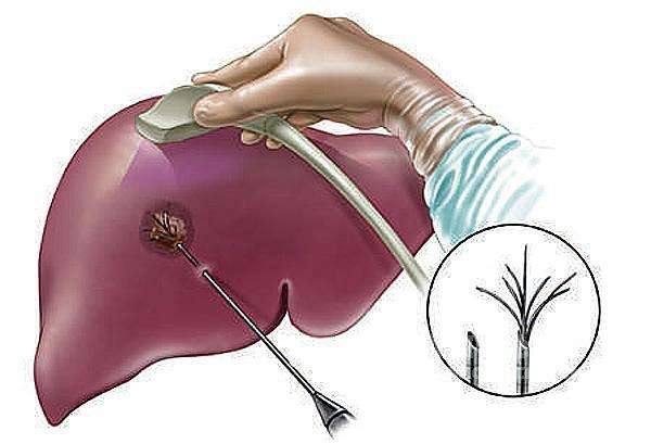 b超可以诊断肝血管瘤吗,肝癌和肝血管瘤ct表现及鉴别诊断