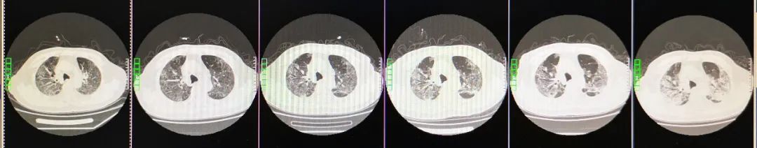 先后7次不同标本核酸检测皆为阴性，但血液中抗体出现动态升高