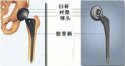 29岁右股骨颈骨折恢复最佳的方法,82老人股骨头摔骨折了该怎样治疗