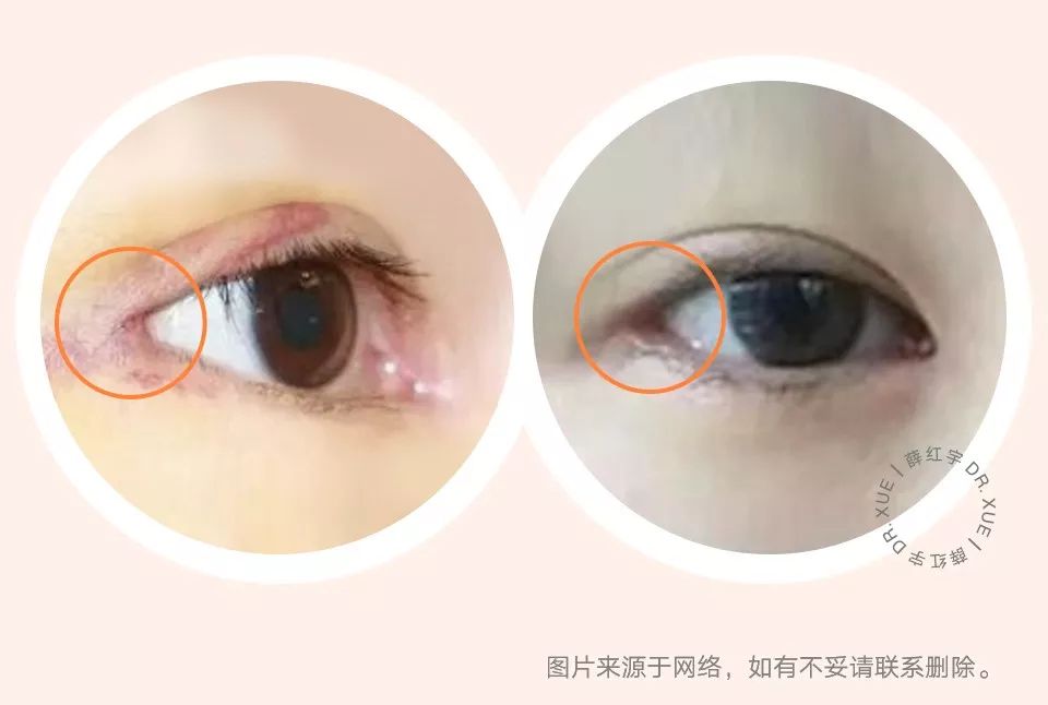 要不要开下眼睑,要不要开内眦赘皮