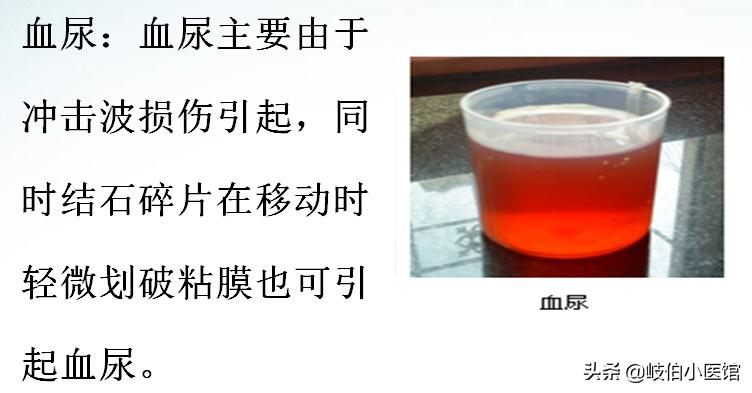 输尿管5mm结石体外冲击波碎石危害,体外冲击波碎石后尿出结石