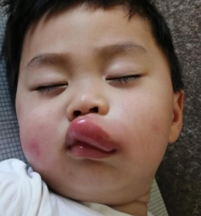 男童被蚊子咬后变成香肠嘴,小孩嘴巴被蚊子亲成香肠怎么办