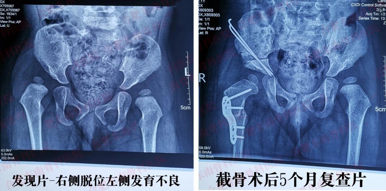 髋关节脱位宝宝保守治疗是怎样的,髋关节脱位宝宝护理