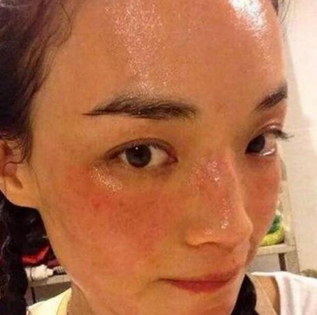 敏感肌红血丝屏障受损如何修复,敏感肌肤改善红血丝最好的方法