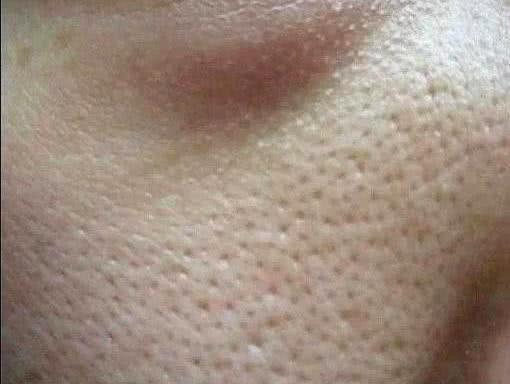 郭鸿财：皮肤毛孔粗大，影响着脸部的美观，这个该怎么改善呢？