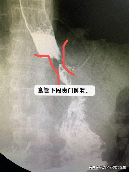 得了食道癌需要戒烟吗,肺癌治疗好了之后发现食管癌